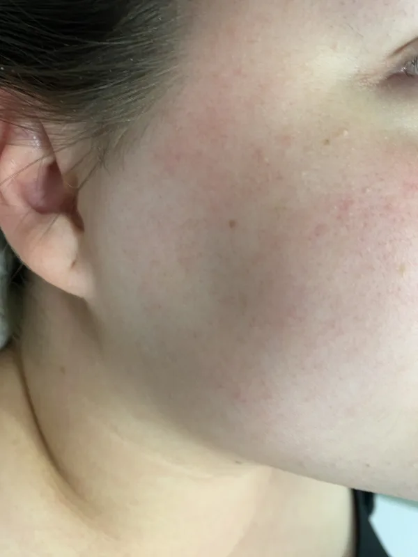 nach Laser-Haarentfernung