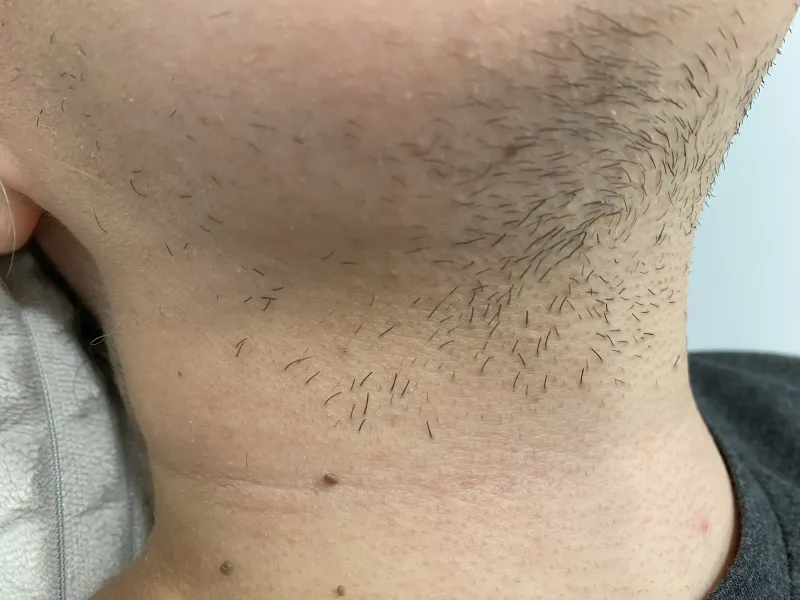 behaarte Hals vor Laser-Haarentfernung