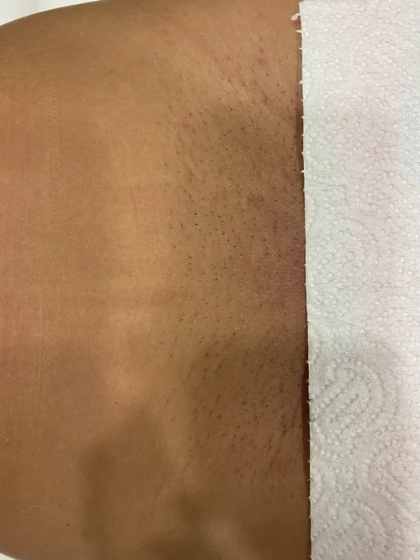 Intim Bereich vor Laser-Haarentfernung