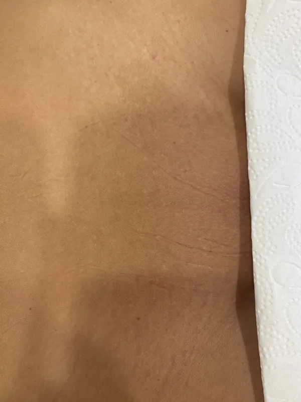 Intim Berech nach der Laser-Haarentfernung