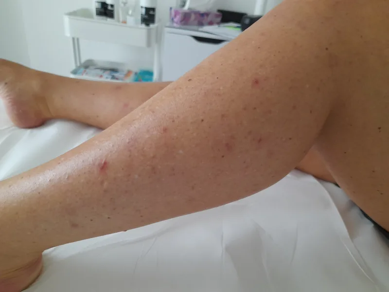 leg before laser hairremoval