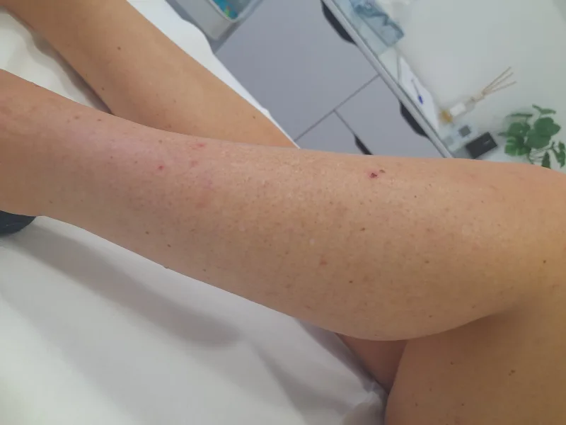 Leg after laser hairremoval
