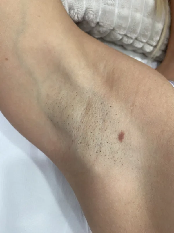 before treatment
