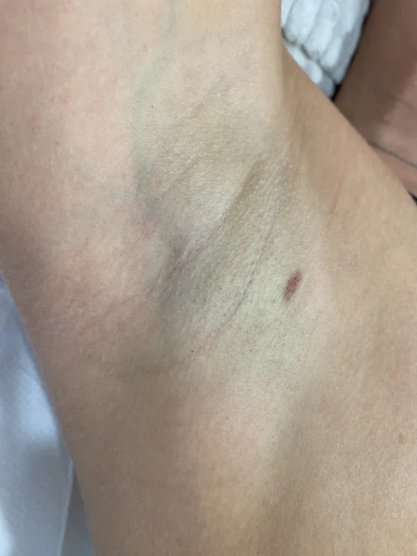 after laser hairremoval