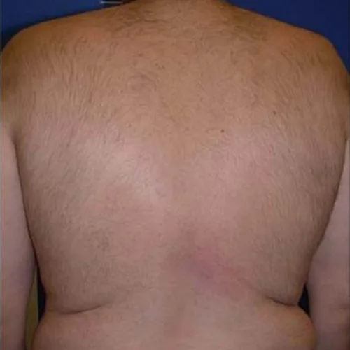 Diódalézeres férfi hát szörtelenítés után