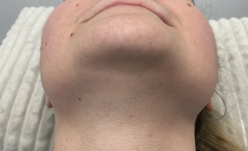 nyak lézeres szörtelenítes