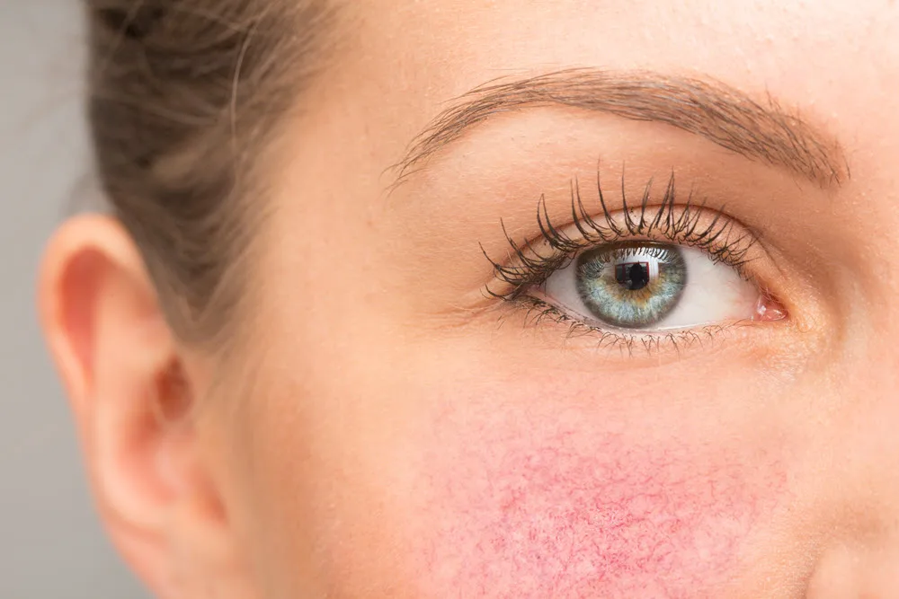 A rosacea egy gyakori, krónikus bőrbetegség, amely elsősorban az arcot érinti.
